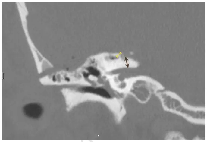 用不同颜色显示在术后冠状位视图中测量的不同距离。棕色：钻磨结束边缘与内听道之间的冠状位距离（N7）；黄色：钻磨起始边缘与上半规管之间的冠状位距离（N8）。