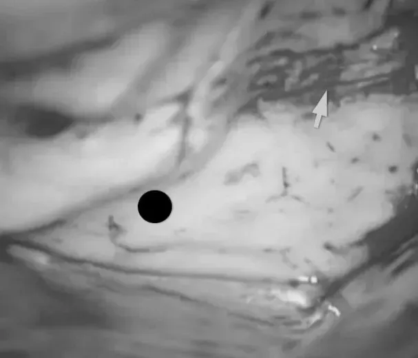 图4：黑点指示钻磨起始点（Kawase三角的后部），箭头指示作为Kawase三角外侧解剖标志的岩大神经。