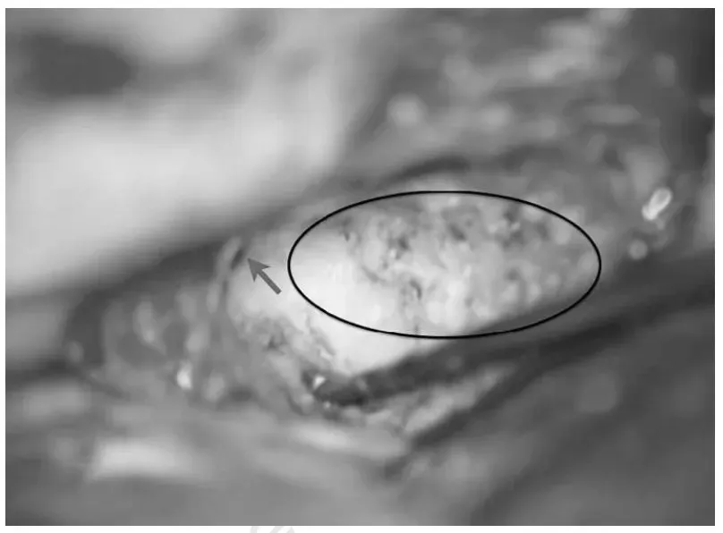 椭圆形区域指示前岩骨切除术后被移除的岩骨部分，箭头指示钻磨的后部结束边缘。