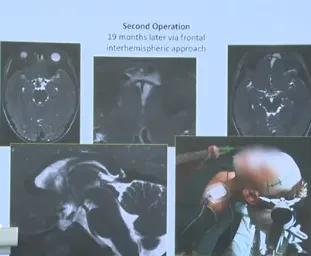 不到2岁遭遇胶质瘤复发，如今的他有了自己的孩子！