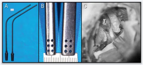 刮匙怎么使用小器械，大作用：一把“吸引刮匙”如何优化听神经瘤手术结果_https://www.jmylbn.com_新闻资讯_第2张