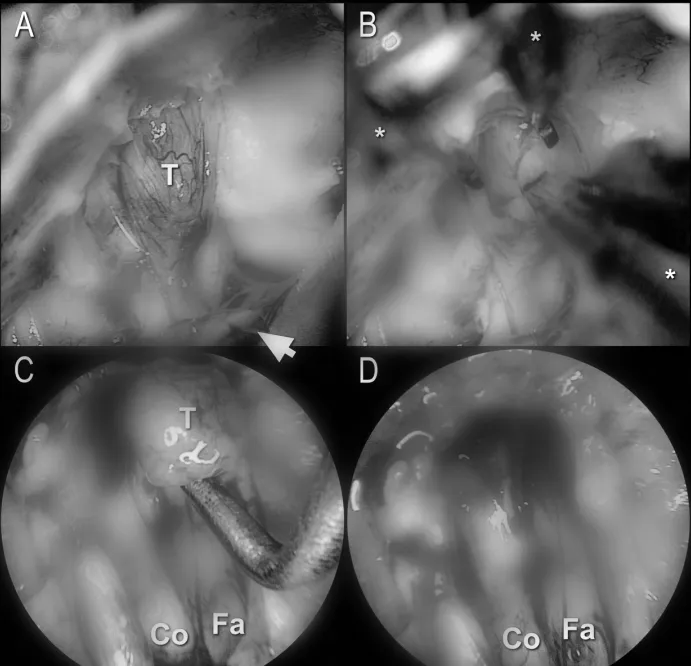 刮匙怎么使用小器械，大作用：一把“吸引刮匙”如何优化听神经瘤手术结果_https://www.jmylbn.com_新闻资讯_第3张