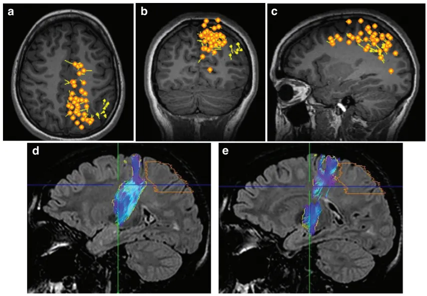 结合弥散张量成像序列（DTI），可以看到蓝紫色的皮质脊髓束，橙色区域是最终被划分出来的手术切除范围。