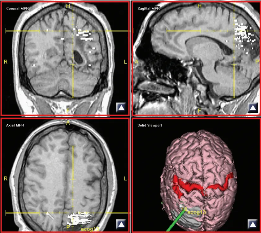 这是一种很有价值的辅助检查技术，能为大多数患者提供精准的定位。