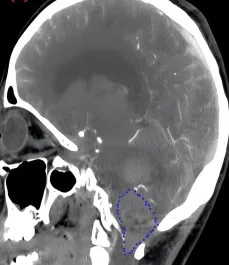 巨大血管母细胞瘤已经出血
