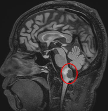延髓背侧血管母细胞瘤