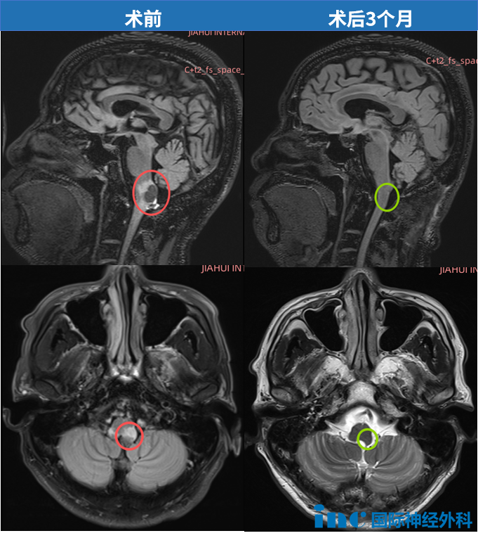 术前术后3个月MRI对比