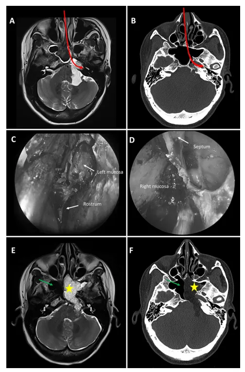 保留一侧蝶窦粘膜的微创入路示意图。