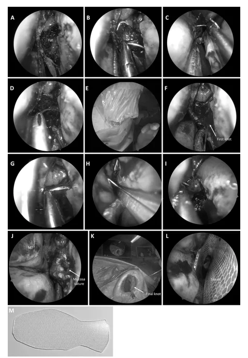 图2. 显示手术缝合步骤的照片。