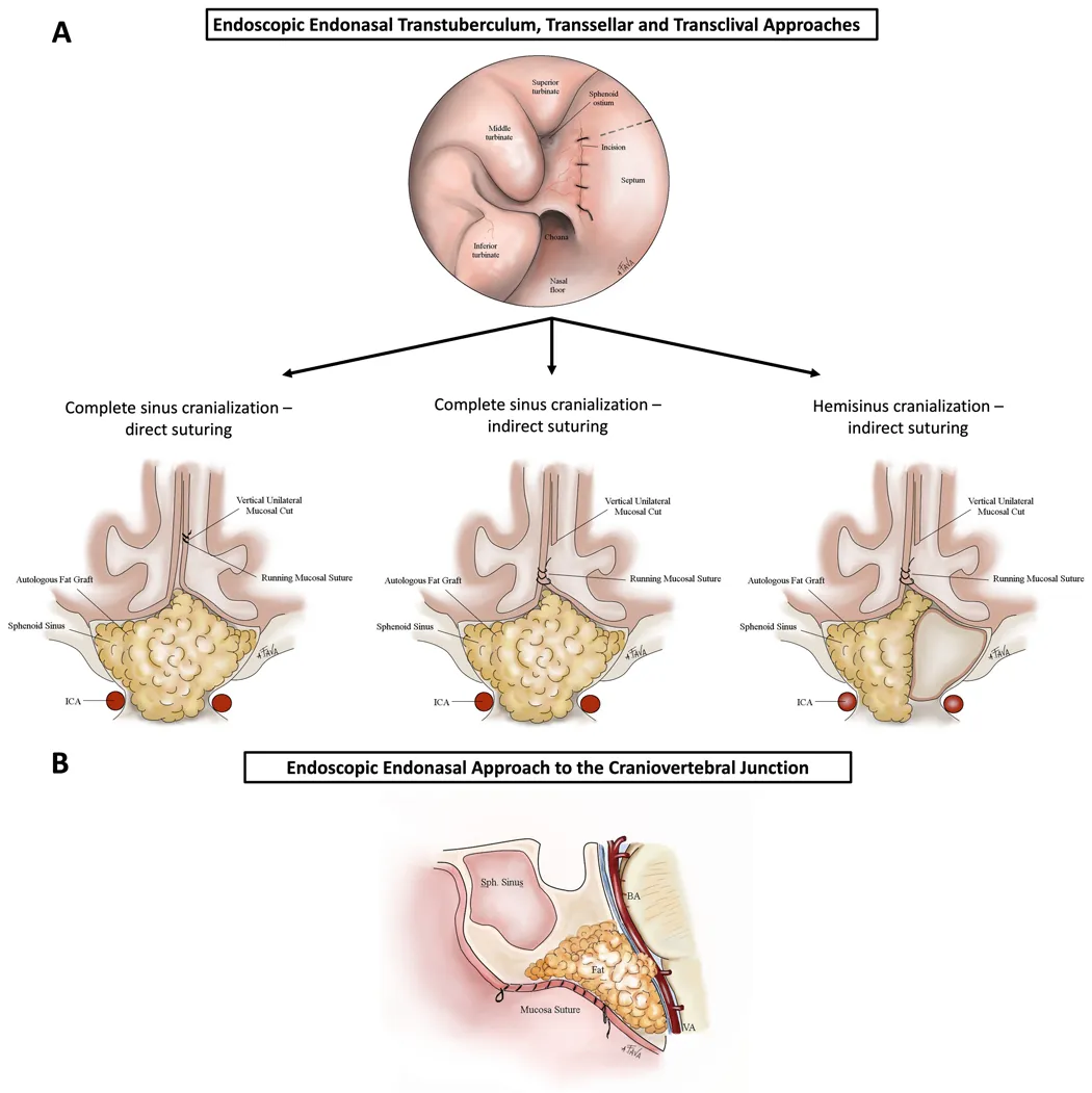 图3. 根据入路在矢状面上粘膜切口闭合示意图。
