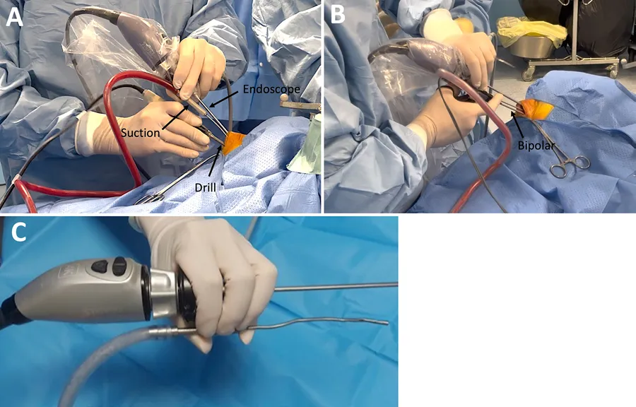 图4. “筷子”技术照片。