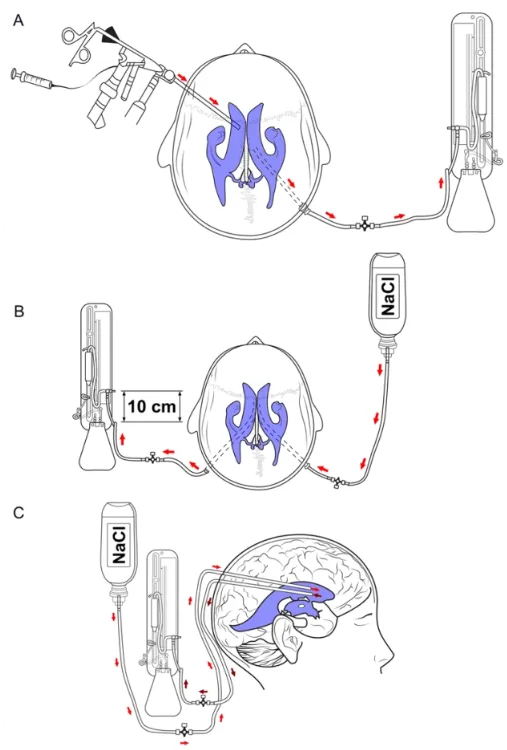在脑室灌洗组中，医生使用了内镜技术（A）或双管技术（B&C）进行灌洗引流。