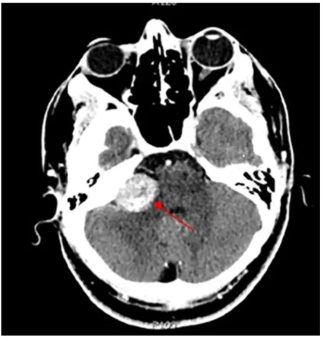 影像学特征高度提示为听神经瘤