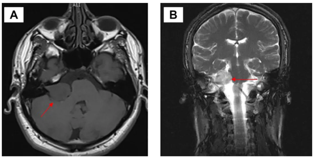 磁共振成像图像（A）轴位面、（B）冠状位面显示：右侧前庭神经鞘瘤主要起源于右侧桥小脑角区，并向内听道内延伸。扫描可见肿瘤对右侧三叉神经存在明显压迫，对脑干存在轻微压迫（红色箭头）。