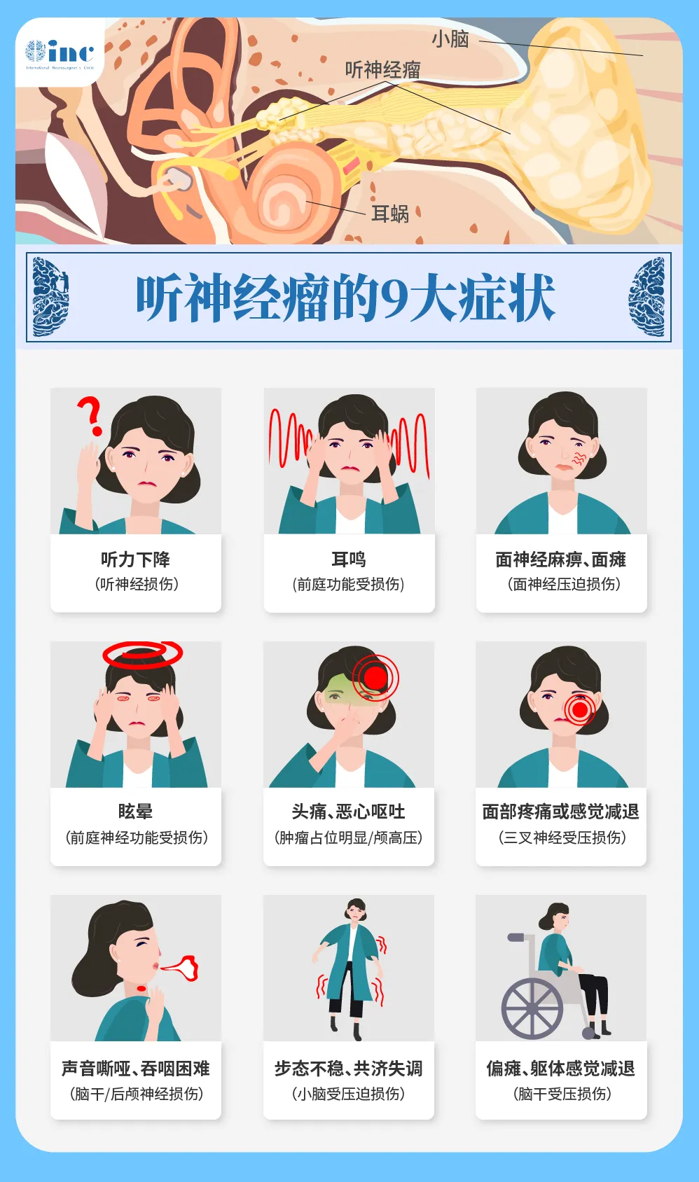 小脑脑桥角区解剖示意图，显示听神经、前庭神经及三叉神经等关键结构的毗邻关系。