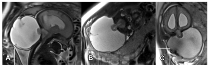 产检发现胎儿脑后长出“大包”，剖腹产后宝宝的情况令人担忧