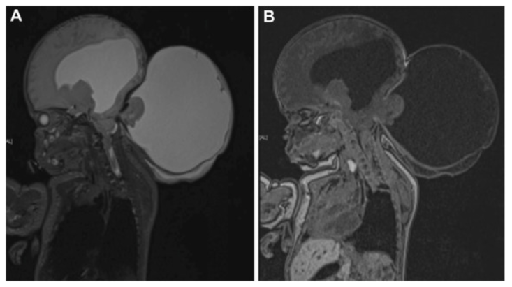脑干下疝、颈髓空洞症和加重的脑积水