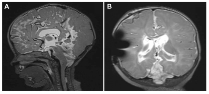 胼胝体、顶叶和枕叶还存在多种脑部异常和小脑萎缩