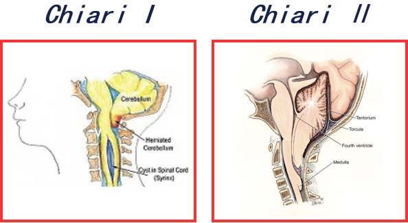 Chiari畸形是一种先天性后颅窝发育畸形疾病，导致小脑向下疝出到椎管。