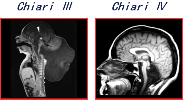 Ⅲ型、Ⅳ型则罕见且严重
