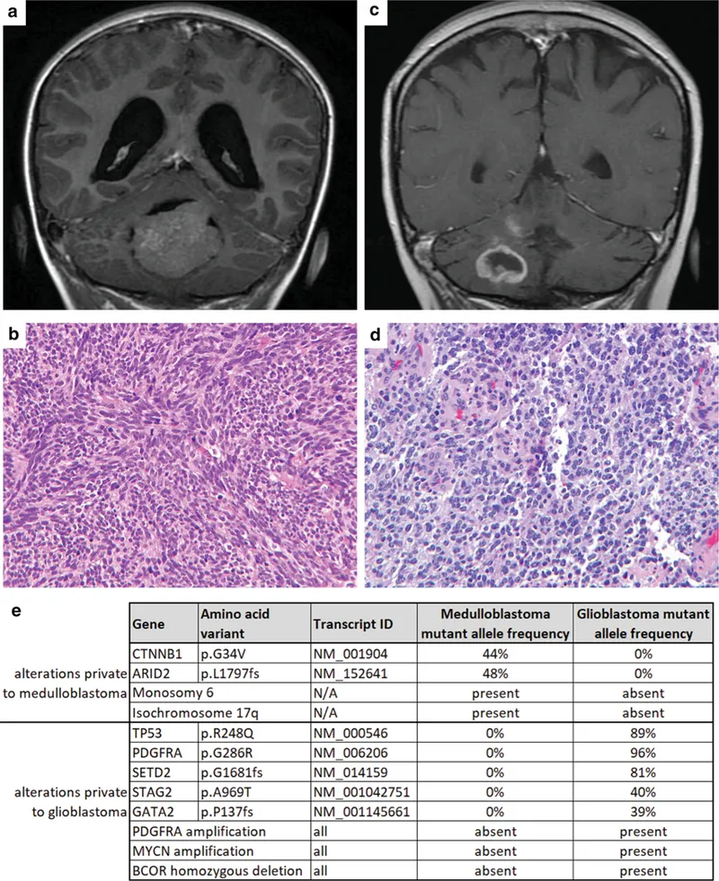 脑瘤手术风险大，放疗就安全？研究发现儿童放疗不仅可能影响发育，还可能诱发胶质瘤