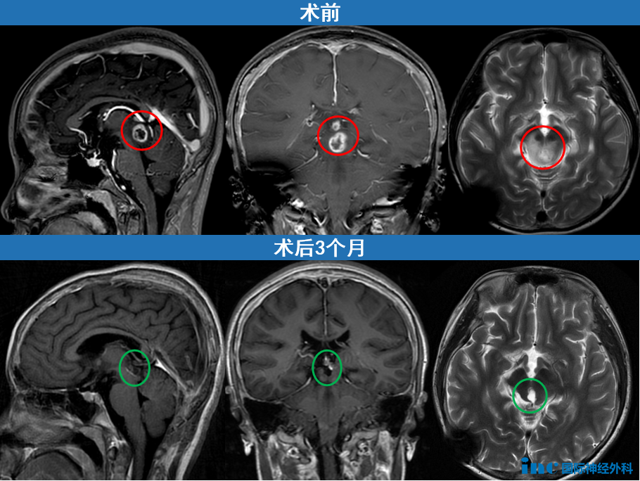 术前  术后3个月