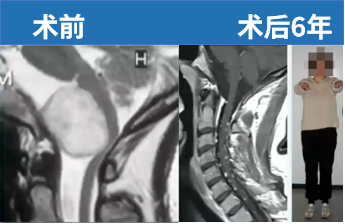 术前术后MRI对比