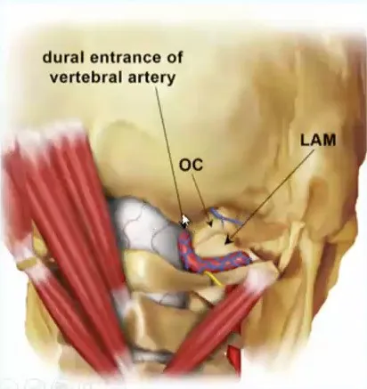 图13.5：经枕髁入路的术野集中在枕骨大孔背缘、椎动脉硬脑膜入口和寰枕关节。