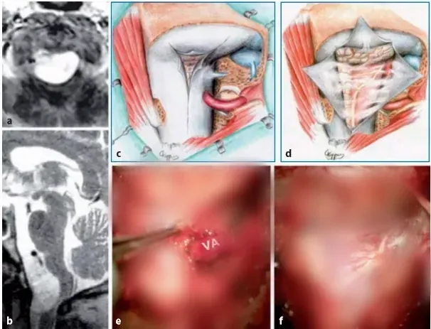 图13.13 a，b术前MR图像（T1-W增强扫描，b矢状T2-W）显示一个大的枕大孔脑膜瘤，该脑膜瘤向背侧生长，严重压迫颈髓。c、图示硬脑膜切开，肿瘤的背外侧和腹侧部分暴露，通过侧面反射硬脑膜和椎动脉的远端V3部分。e、 f相应的术中照片显示通过侧面反射硬脑膜，可以直接接触到肿瘤基底的硬脑膜（VA，椎动脉）