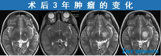 靶向治疗3个月，只换来胶质瘤复发！咨询大咖后有了“新解法”