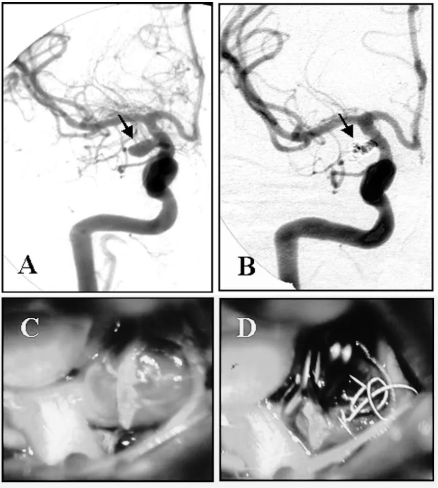 （A）右侧颈内动脉（ICA）血管造影显示右侧后交通动脉动脉瘤（箭头所示）。   （B）栓塞术后2周血管造影显示动脉瘤瘤颈残余（箭头所示）。   （C）术中照片显示动脉瘤囊被弹簧圈扩张。   （D）动脉瘤已夹闭，并经动脉瘤壁取出弹簧圈。