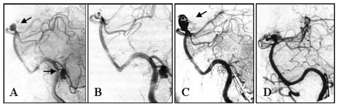 （A）左侧椎动脉造影显示基底动脉顶端动脉瘤及左侧小脑后下动脉动脉瘤（箭头所示）。   （B）基底动脉动脉瘤经弹簧圈次全栓塞，小脑后下动脉动脉瘤初期未处理。   （C）弹簧圈栓塞术后2年随访造影显示基底动脉顶端动脉瘤复发（箭头所示），小脑后下动脉动脉瘤已闭塞。   （D）基底动脉动脉瘤夹闭术后1年随访造影。