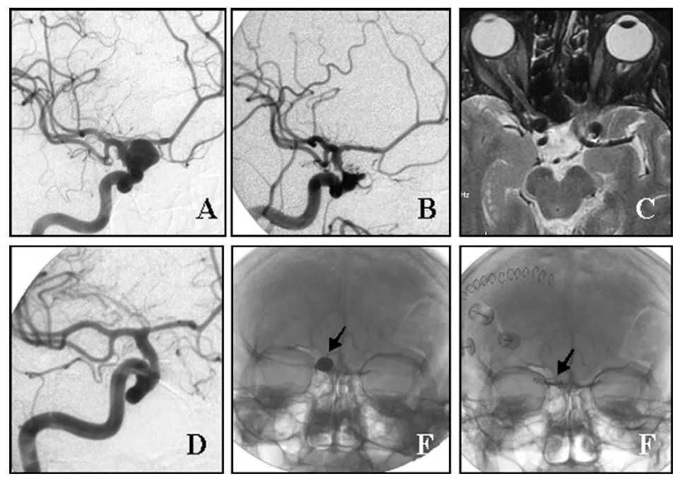 （A）诊断性血管造影显示右侧眼动脉动脉瘤。   （B）栓塞术后22个月，患者出现右眼视力下降；弹簧圈栓塞术后2年血管造影显示动脉瘤闭塞率为90%。   （C）术前MRI显示弹簧圈团块压迫右侧视神经。   （D）术后血管造影显示动脉瘤完全闭塞。  E、F）术前与术后颅骨X线片，分别显示栓塞弹簧圈的位置与弹簧圈取出后动脉瘤夹的位置（箭头所示）。
