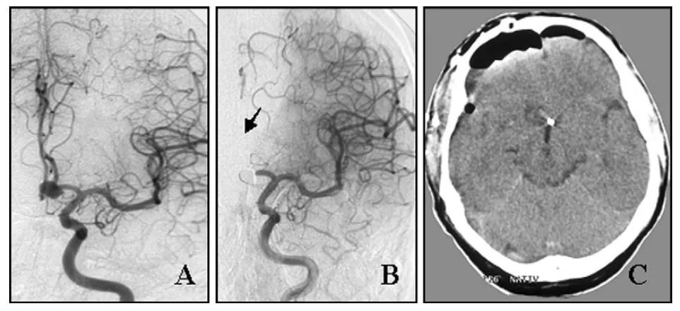 （A）栓塞术前血管造影显示左侧前交通动脉动脉瘤。   （B）栓塞术后即刻血管造影显示动脉瘤致密栓塞，左侧大脑前动脉A2段闭塞。   （C）术后CT扫描未见大脑半球梗死。