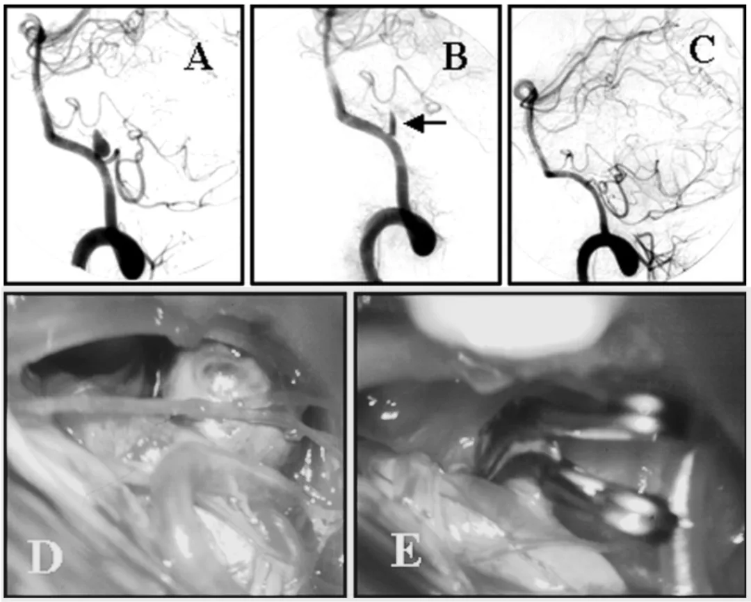 （A）左侧椎动脉数字减影血管造影（DSA）显示椎动脉 - 小脑后下动脉动脉瘤。  （B）栓塞术后即刻血管造影未见左侧小脑后下动脉显影，原因为动脉瘤内血栓形成并蔓延至左侧小脑后下动脉近端（箭头所示）。  （C）动脉瘤夹闭并血栓切除术后血管造影，动脉瘤已完全闭塞。  （D）弹簧圈栓塞失败后，动脉瘤瘤顶被完整血栓填塞扩张。  （E）动脉瘤夹闭并血栓切除术后术中照片。