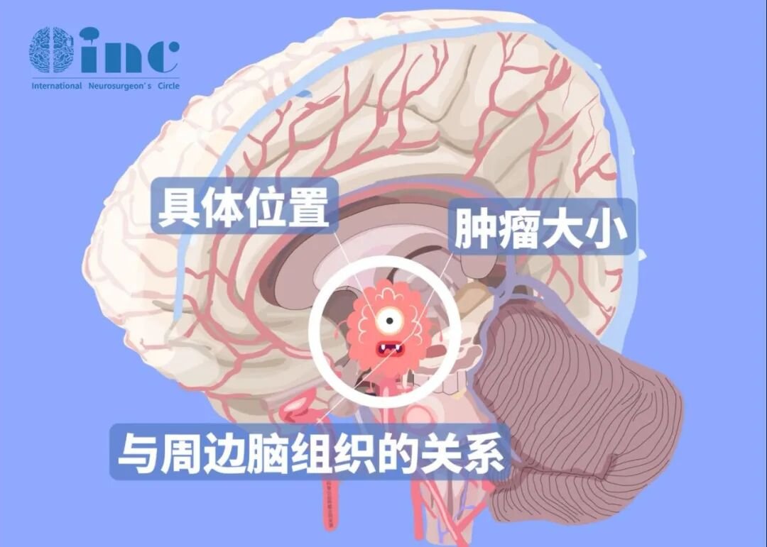 手术方法大致可分为经颅技术和经鼻手术，选择取决于肿瘤位置及与周围结构的关系。