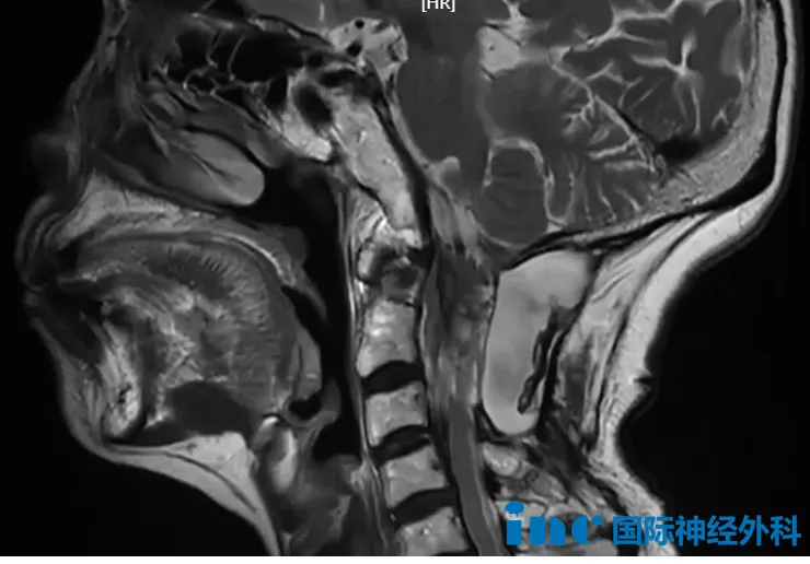 年过七旬的陈女士，颈椎C1-2脊膜瘤复发，突发晕厥，伴失忆查出来的。