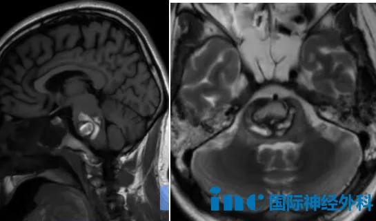 脑干海绵状血管瘤突发出血
