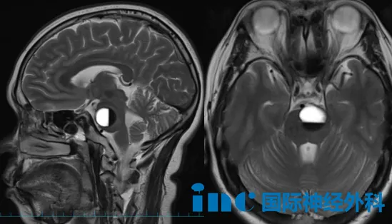 脑干海绵状血管瘤
