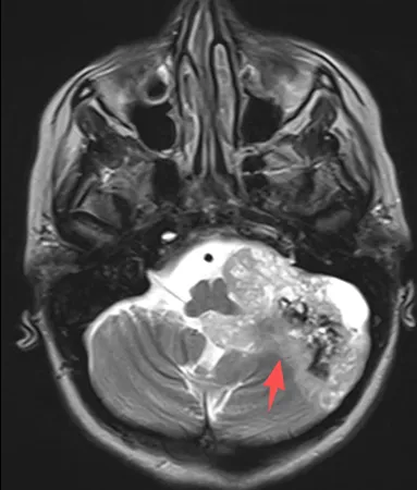 仅仅头痛，19岁女孩脑中罕见胶质瘤与5对颅神经“纠缠”，医生如何巧妙化解？