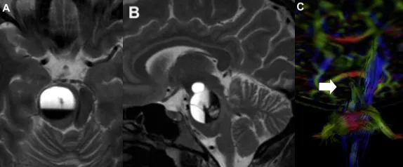 怀孕后确诊脑干出血，手术和生子，我应该先选哪个？