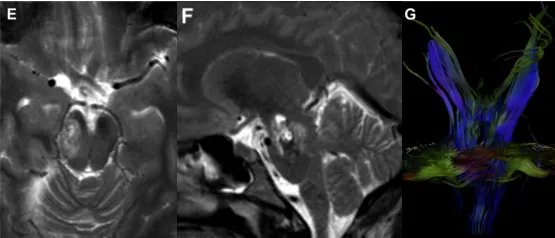 术后一周，该孕妇恢复良好，术前症状有所改善，并在怀孕40周顺利分娩，母子平安。