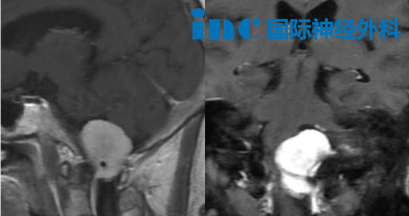 高难度的枕骨大孔区脑膜瘤手术