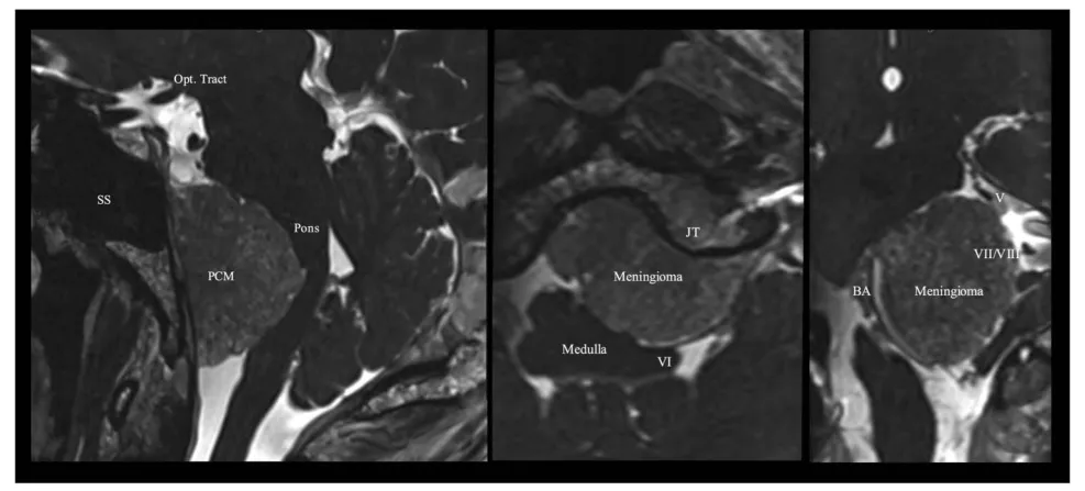 图2. 术前栓塞后，采用稳态构成干涉序列的多平面重建磁共振成像，显示脑膜瘤与神经血管结构的关系。BA，基底动脉；JT，颈静脉结节；Opt. Tract，视束；PCM，岩斜区脑膜瘤；SS，蝶窦；V，第五对颅神经；VI，第六对颅神经；VII/VIII，第七和第八对颅神经。