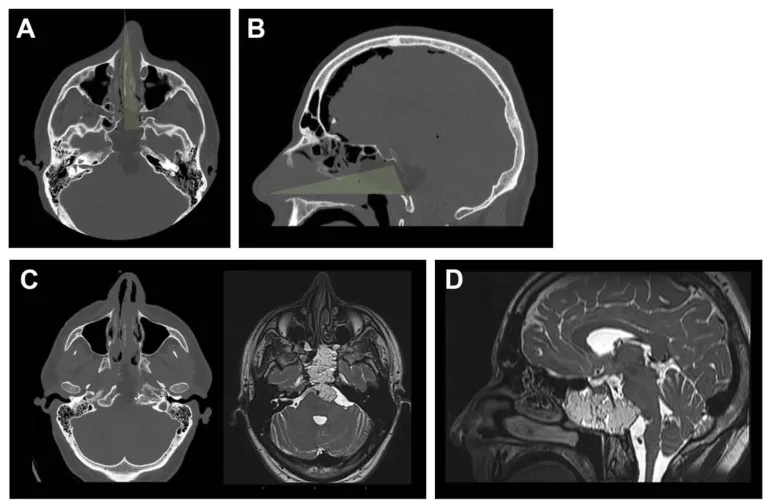 图3. 术后影像及结果。A和B，术后计算机断层扫描的轴位和矢状位视图，展示了保留鼻腔完整性的单鼻孔目标性入路。鼻中隔、上颌窦、后组筛窦及左侧蝶窦间隔保持完整。C，为显露肿瘤外侧部分，磨除了左侧颈静脉结节。D，蝶窦被颅腔化并用自体脂肪填充，同时缝合了头端黏膜。实现了肿瘤全切，且未检测到脑脊液漏。