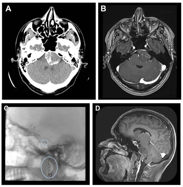 图1. A和B，脑部计算机断层扫描及增强磁共振成像的轴位视图，显示一强化不均匀的低位左侧岩斜区脑膜瘤。C，术前咽升动脉和脑膜垂体干的栓塞。D，磁共振成像矢状位视图显示岩斜区脑膜瘤的部分去血管化。