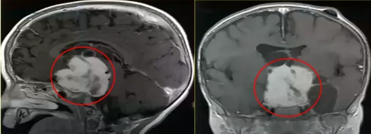 鞍区肿瘤侵犯性生长，考虑视路胶质瘤。