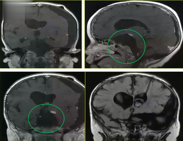 小禾克服了内心的害怕，最终在巴爷爷的主刀下熬过了艰难的几个小时，成功全切肿瘤。