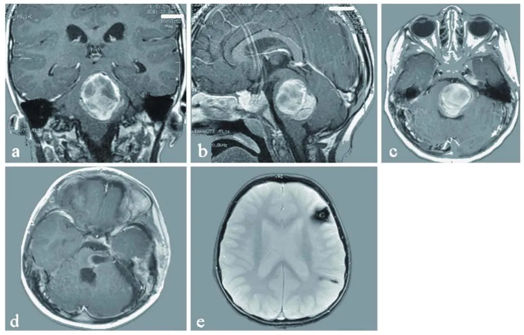 3岁女童脑干海绵状血管瘤术后，医生为什么坚持给她父母也做基因检测？