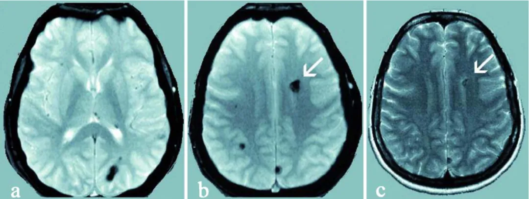 女孩和***妈体内存在一个相同的、全新的CCM1基因突变，而父亲没有。